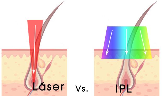 laser-vs-ipl